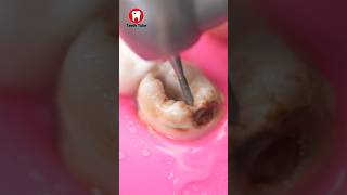 Decayed Tooth Reconstruction faketooth toothfilling toothdecay shorts [upl. by Avat881]