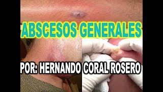 ABSCESOS GENERALES  INFECCIÓN E INFLAMACIÓN INTERNA O EN LA PIEL [upl. by Omero484]