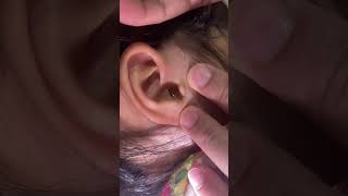 Ear Cleaning by Olive Oil earcleaning oliveoil tepy [upl. by Erdei993]