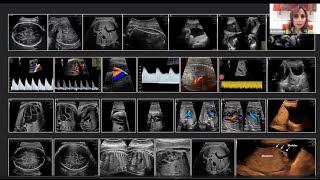 New ISUOG Practice Guidelines The performance of a thirdtrimester obstetric ultrasound scan [upl. by Jolee]