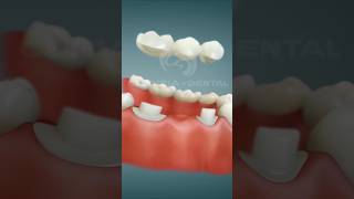 Use earphone Dental Bridge Porcelain Procedure after extraction satisfying [upl. by Akoek470]