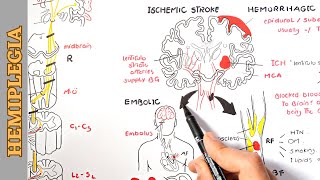 Hemiplegia part 1  causes pathophysiology stages and manifestations [upl. by Hein]