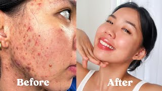 ENG SUB HOW I GOT RID OF MY ACNE SCARS TEXTURE amp HYPERPIGMENTATION not sponsored [upl. by Emoreg]