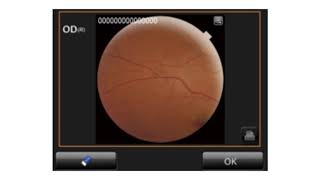 Peripheral Fundus Photography on the TRC NW400 [upl. by Malloy386]