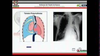 Neumotorax a Tension [upl. by Gnanmas]