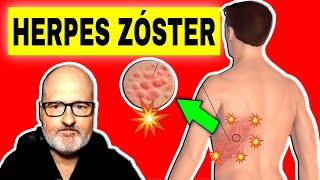 HERPES ZOSTER Culebrilla Síntomas Causas y Tratamiento 🔴 [upl. by Eceined]