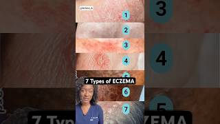 7 Eczema Types How to Tell Which One You Have [upl. by Bond]