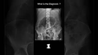 Caecal volvulus Abdominal Xray  Abnormalities  Caecal volvulus 75 radiologychannel007 [upl. by Devaney119]