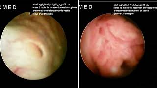 CYSTOSCOPIEtumeurdevessieورم المثانة [upl. by Adnima]