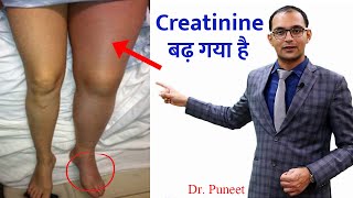 What are the sign and symptoms of high creatinine levels Dr puneet dhawan  karma ayurveda [upl. by Enelrats]