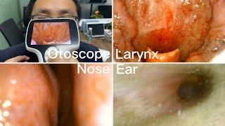 ENT Endoscopy Ear Nose Throat Examination  Using BESDATA Handheld Portable Otoscope [upl. by Ahsekyt]