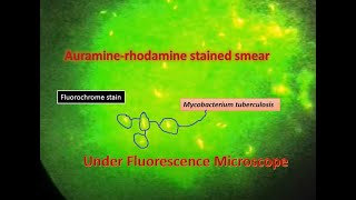 Auramine phenol stain Mycobacterium positveFluorescence microscope [upl. by Enomed]