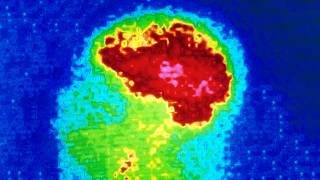 A Woman Put Mercury Skin Cream On Her Face This Is What Happened To Her Brain [upl. by Neelyhtak]