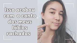 COMO ACABEI COM O CANTO DA BOCA E OS LÁBIOS RACHADOS [upl. by Sula]