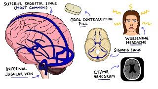 Cerebral Venous Sinus Thrombosis CVST  With Dural Venous Sinuses Anatomy [upl. by Behnken198]