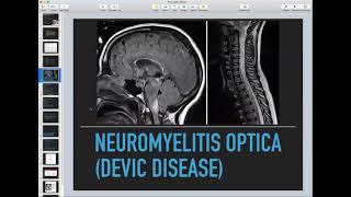 Transverse Myelitis Neuromyelitis Optica Acute Disseminated Encephalomyelitis  Neurology Course [upl. by Aropizt]