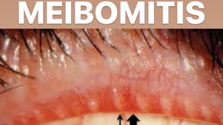 MEIBOMITIS  DISEASE OF EYELID [upl. by Ahsinned]