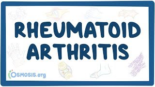 Rheumatoid arthritis  causes symptoms diagnosis treatment pathology [upl. by Kindig]