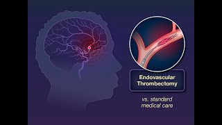 Endovascular Thrombectomy for Large Ischemic Strokes  NEJM [upl. by Ardie319]