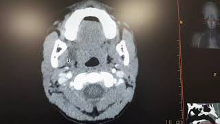 Submandibular cyst ct [upl. by Bodi]