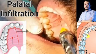 Local Anesthesia Palatal Infiltration Technique Maxillary Anesthesia Techniques dentistry [upl. by Aciram]