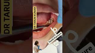 FRACTURE TOOTH keep it or fix it tooth😱😱 viralvideo shorts fracture tooth [upl. by Aihtenak905]