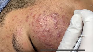 Blackheads amp Pimples Pore Removal New 2024  Acne Treatment With Bo Nguyễn Spa 024 [upl. by Haimirej]