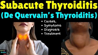 Subacute Thyroiditis De Quervain’s Thyroiditis – Causes Symptoms Diagnosis and Treatment [upl. by Ertnom]