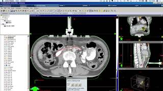 Celiac Plexus Radiosurgery contouring the bowel [upl. by Jenei]