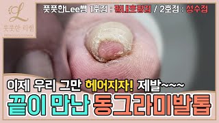 ENG SUB끝이 만난 동그라미발톱 이제 그만 헤어지자 ingrown toenail  ingrowing nail  Fresh Foot 풋풋한리쌤 성수점  평내호평점 [upl. by Hsemar]