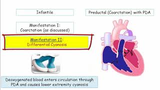 12DaysinMarch Aortic Disorders Part II  Coarctation and Aortitis for USMLE Step One [upl. by Francesco]