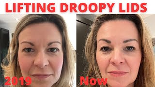 How to lift droopy hooded eyelids without surgery [upl. by Nerred]