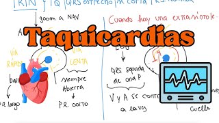 FISIOPATOLOGÍA de las ARRITMIAS con sus TRATAMIENTOS [upl. by Dnalerb]