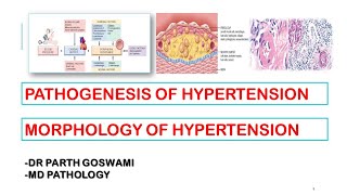 Hypertension  Pathogenesis  Morphology  Arteriosclerosis [upl. by Tenaej]