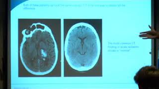 FASTED Stroke Presentation [upl. by Ssenav]