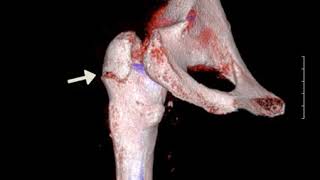 Comminuted Fracture Of The Left Greater Trochanter [upl. by Rafferty67]