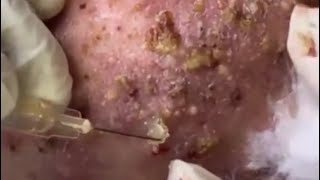 Blackheads amp Milia Big Cystic Acne Blackheads Extraction Whiteheads Removal Pimple Popping EP3 [upl. by Maribelle]