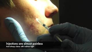 Dermal Fillers for acne scars [upl. by Joana]