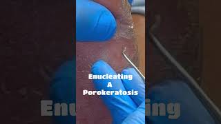 Enucleating A Porokeratosis [upl. by Ronen]