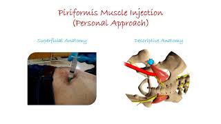 Piriformis Muscle Injection  Personal Approach [upl. by Siriso]