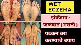 जळवात उपचार । Eczema treatment in marathi । jaivat upay marathi । Marathi solution [upl. by Chapland]