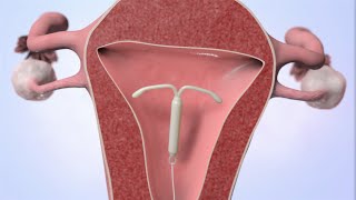 Patient Education Video Intrauterine Device IUD [upl. by Niki56]