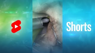 What is Endoscopic Lumbar Foraminotomy Shorts [upl. by Naitsabes]