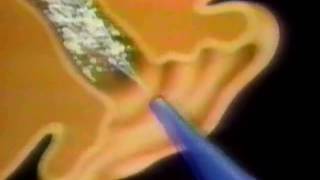 Murine Ear Wax Removal System commercial  1992 [upl. by Elodie]