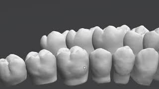 9Dental Caries Classification Part3 1 [upl. by Aremat873]