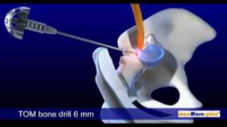 DB 115 Endoskopische Bandscheibenoperation  PAL 169  DB 115 Endoscopic Disc surgery  PAL 169 [upl. by Einnus]