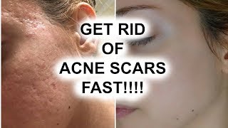 HOW TO GET RID OF ACNE SCARS  Pershii [upl. by Aprile]