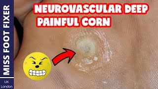 Neurovascular DEEP PAINFUL Corn Removal  Full Thickness Corn  BY MISS FOOT FIXER [upl. by Egarton431]