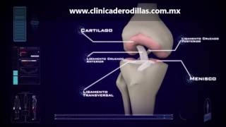 Clinica de Rodillas  Ruptura Parcial Ligamento Cruzado Anterior LCA  México [upl. by Eletnahc]