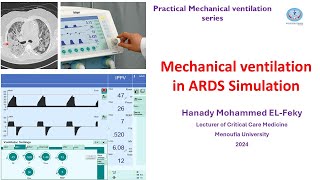 Simulation of Ventilator settings in ARDS in Arabic [upl. by Leveroni209]